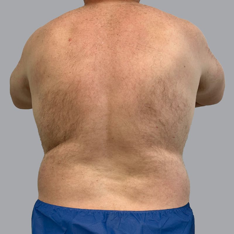 Body Liposuction Before & After Gallery - Patient 362628 - Image 1