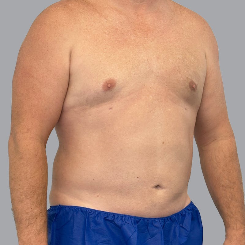 Gynecomastia Before & After Gallery - Patient 119810 - Image 4