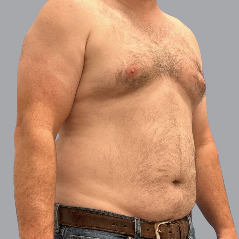 Gynecomastia Before & After Gallery - Patient 119810 - Image 3