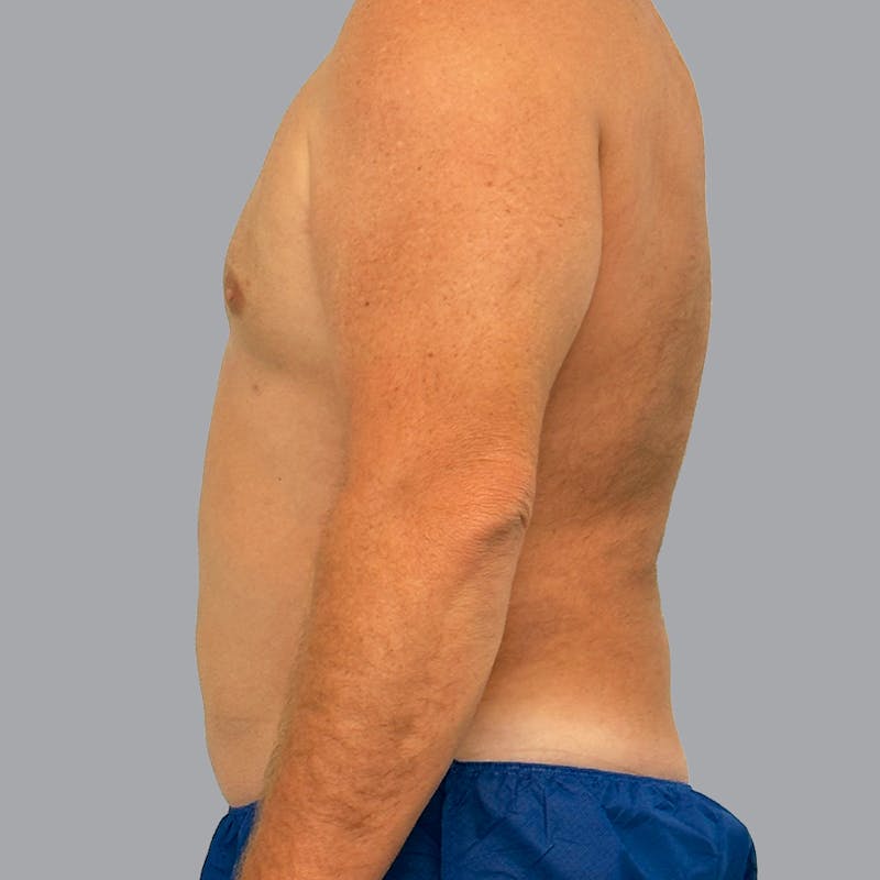 Body Liposuction Before & After Gallery - Patient 257355 - Image 8