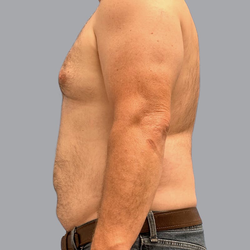 Gynecomastia Before & After Gallery - Patient 119810 - Image 5