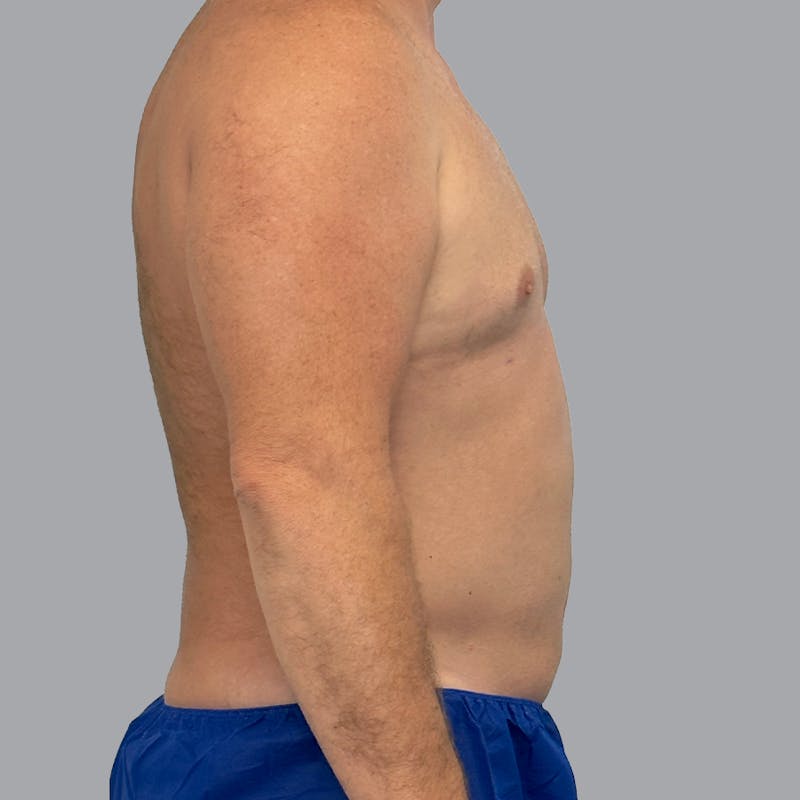 Body Liposuction Before & After Gallery - Patient 257355 - Image 6