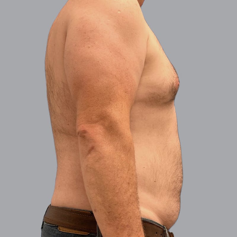 Gynecomastia Before & After Gallery - Patient 119810 - Image 7