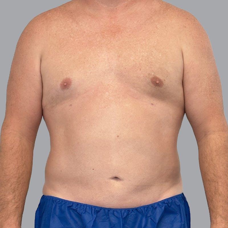 Body Liposuction Before & After Gallery - Patient 257355 - Image 2