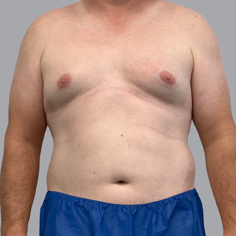 Gynecomastia Before & After Gallery - Patient 119810 - Image 1