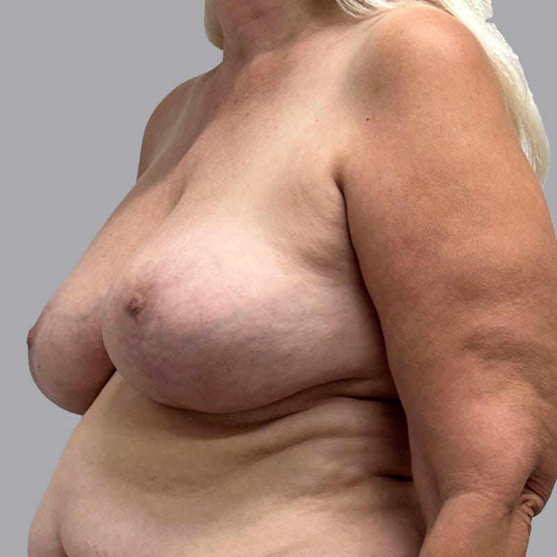 Breast Lift Before & After Gallery - Patient 435568 - Image 8