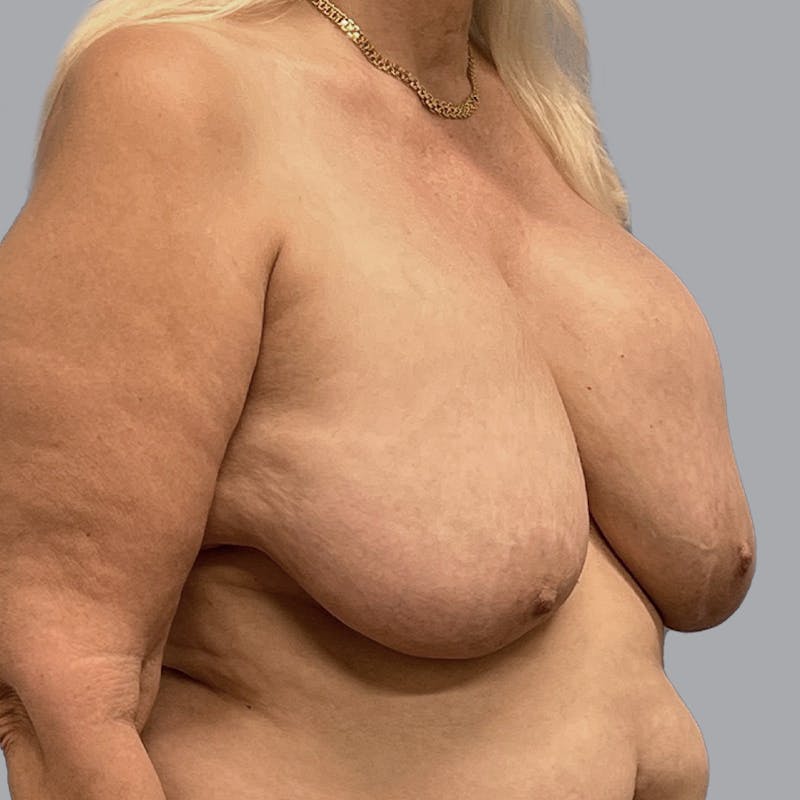Breast Implant Removal Before & After Gallery - Patient 326434 - Image 3