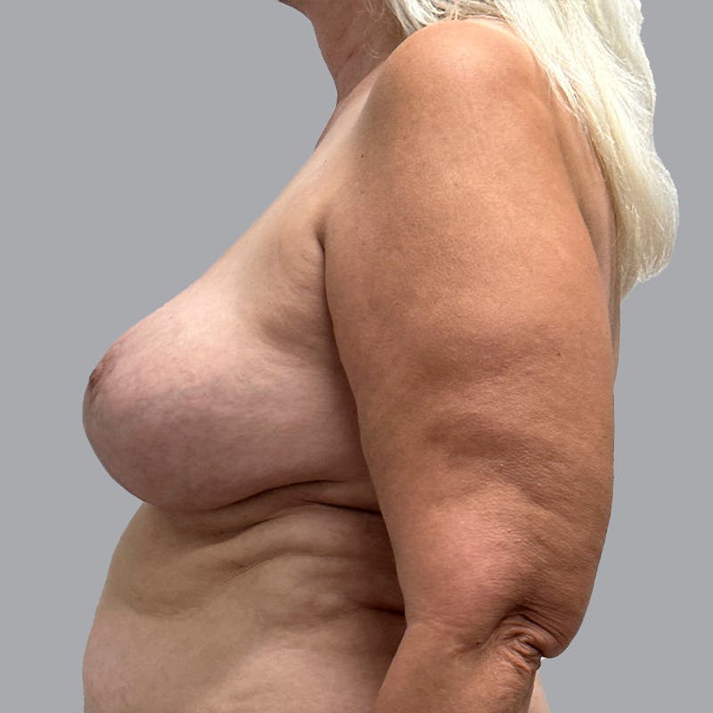 Breast Lift Before & After Gallery - Patient 435568 - Image 10