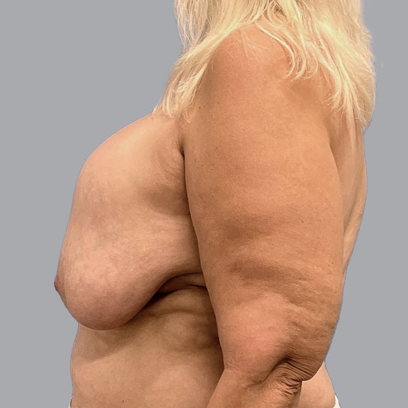 Breast Lift Before & After Gallery - Patient 435568 - Image 9