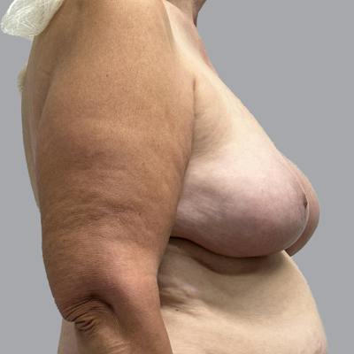 Breast Implant Removal Before & After Gallery - Patient 326434 - Image 6