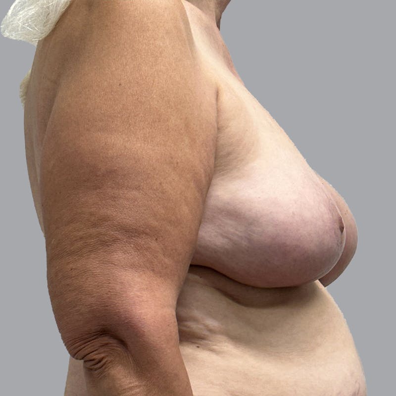 Breast Implant Removal Before & After Gallery - Patient 326434 - Image 6