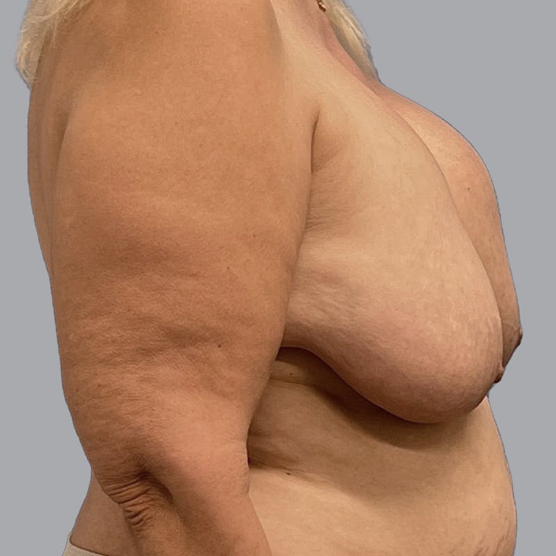 Breast Lift Before & After Gallery - Patient 435568 - Image 5