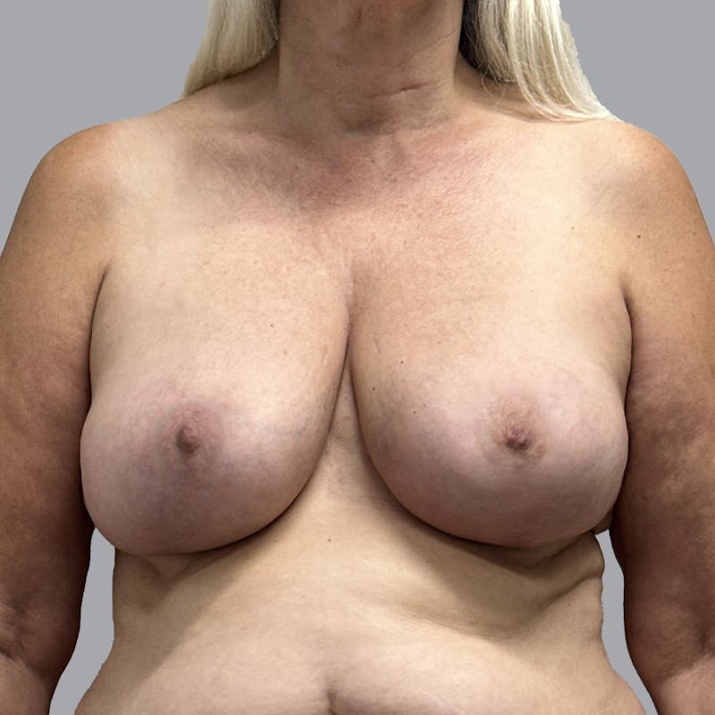 Breast Lift Before & After Gallery - Patient 435568 - Image 2