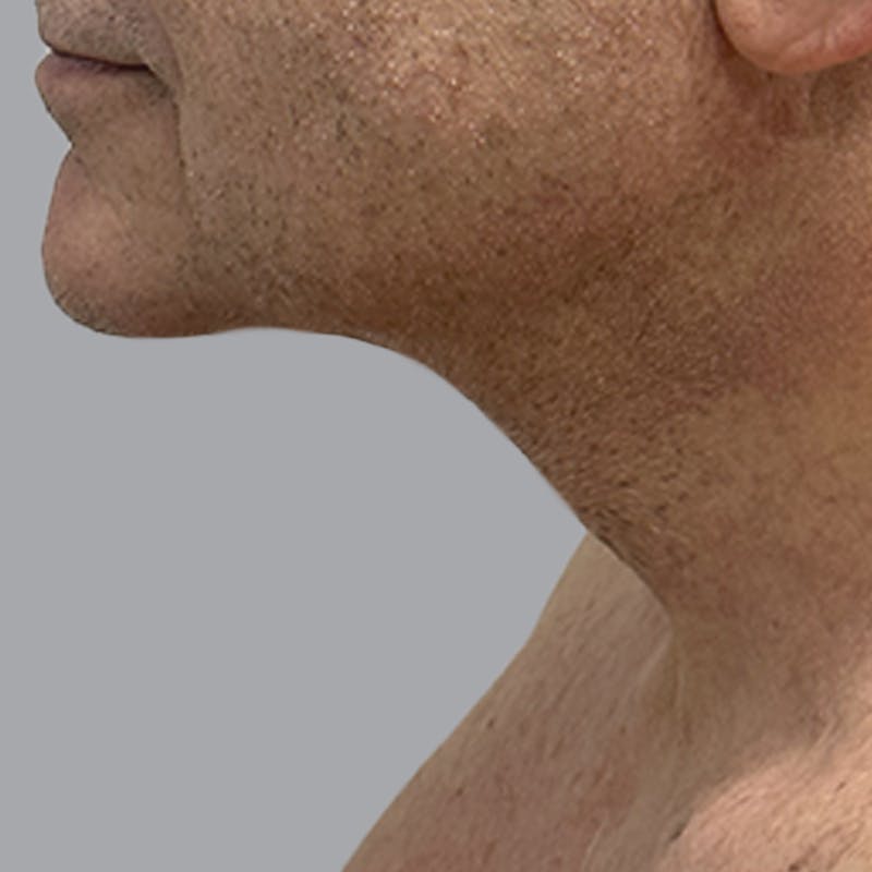 Facelift and Neck Lift Before & After Gallery - Patient 225592 - Image 6