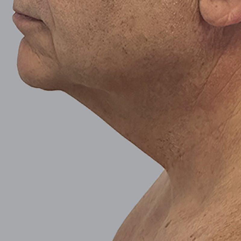 Facelift and Neck Lift Before & After Gallery - Patient 225592 - Image 5
