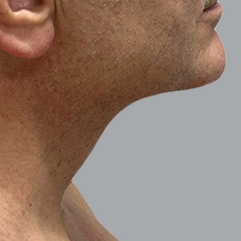 Facelift and Neck Lift Before & After Gallery - Patient 225592 - Image 4