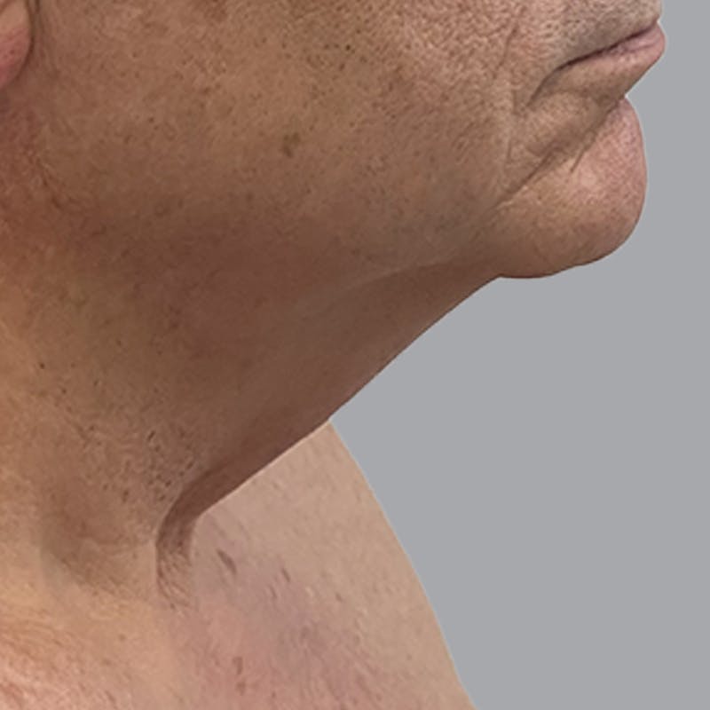 Facelift and Neck Lift Before & After Gallery - Patient 225592 - Image 3