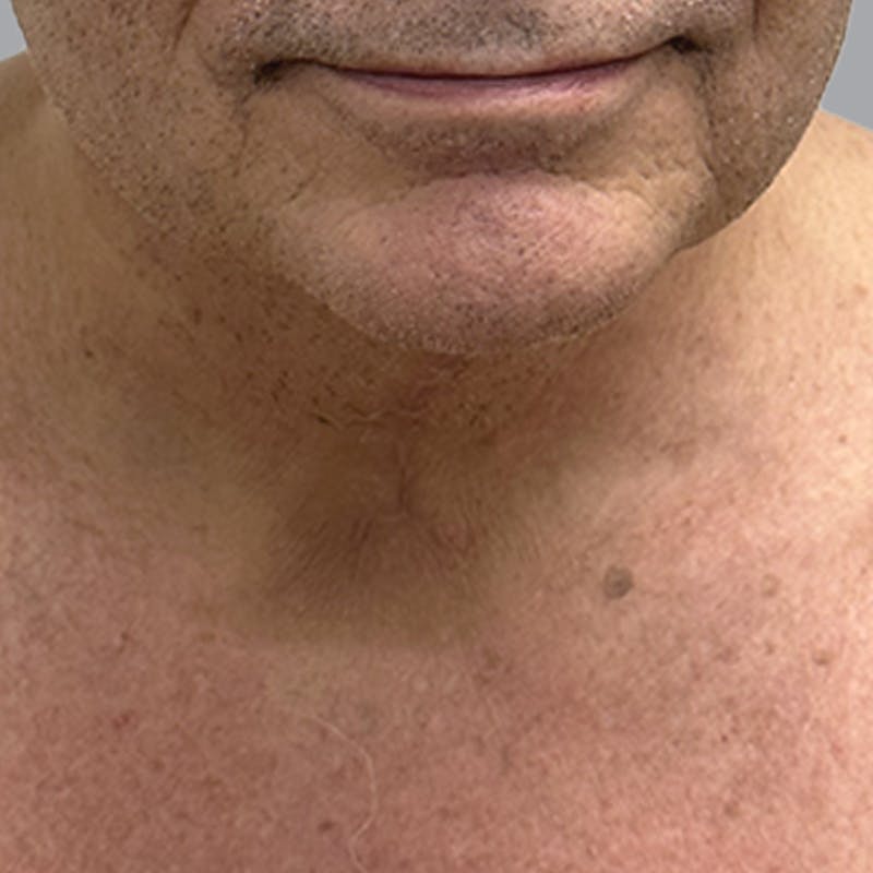 Facelift and Neck Lift Before & After Gallery - Patient 225592 - Image 2
