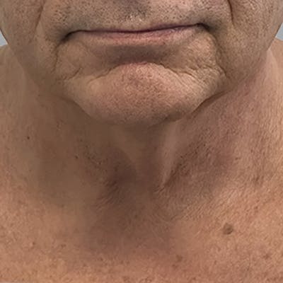 Facelift and Neck Lift Before & After Gallery - Patient 225592 - Image 1