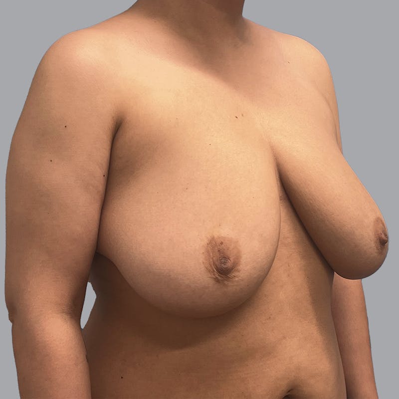 Breast Reduction Before & After Gallery - Patient 300427 - Image 3