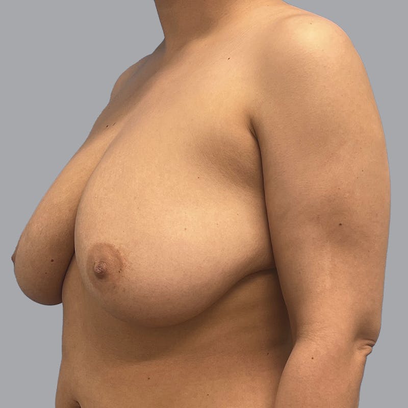 Breast Reduction Before & After Gallery - Patient 300427 - Image 5