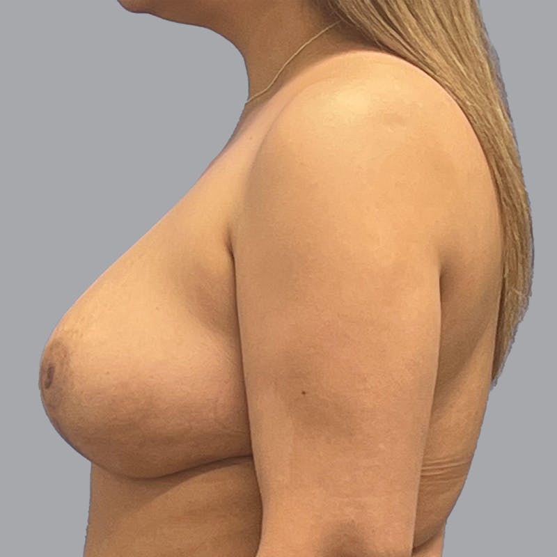 Breast Reduction Before & After Gallery - Patient 300427 - Image 8