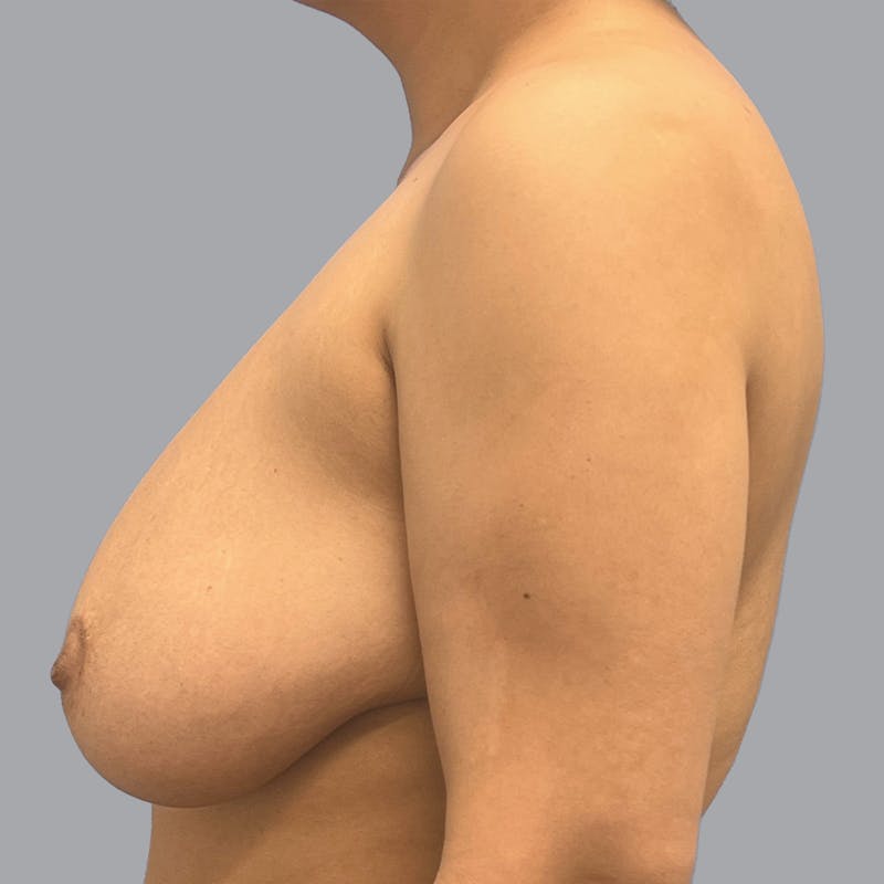 Breast Reduction Before & After Gallery - Patient 300427 - Image 7