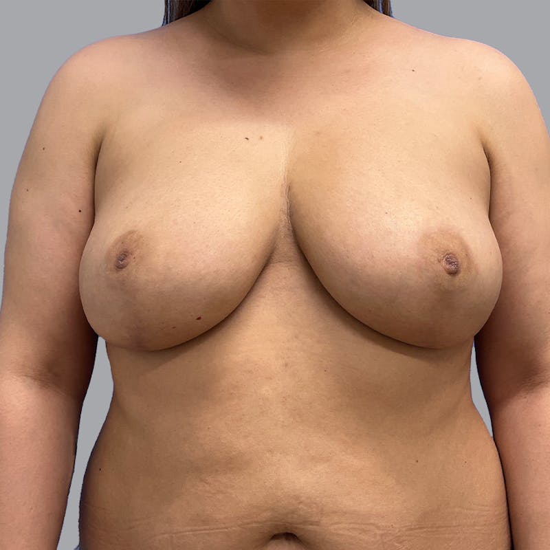 Breast Reduction Before & After Gallery - Patient 300427 - Image 2