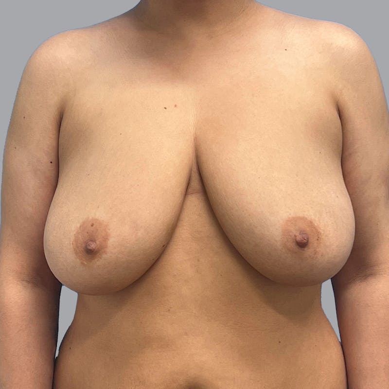 Breast Reduction Before & After Gallery - Patient 300427 - Image 1