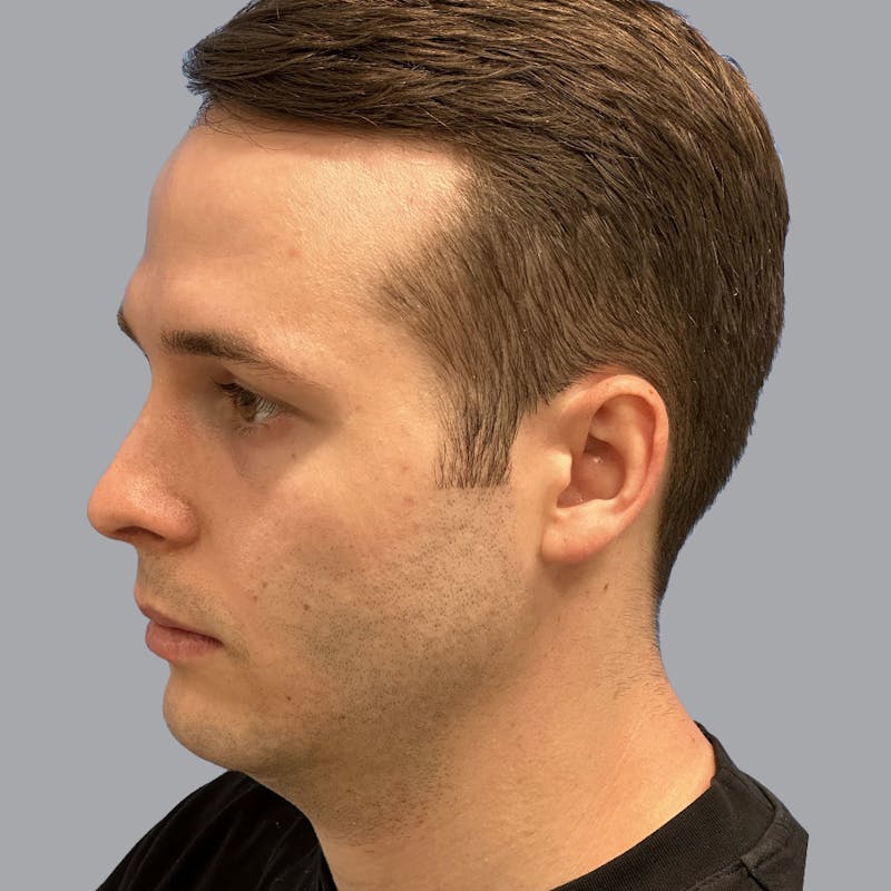 Chin Lipo Before & After Gallery - Patient 233029 - Image 5