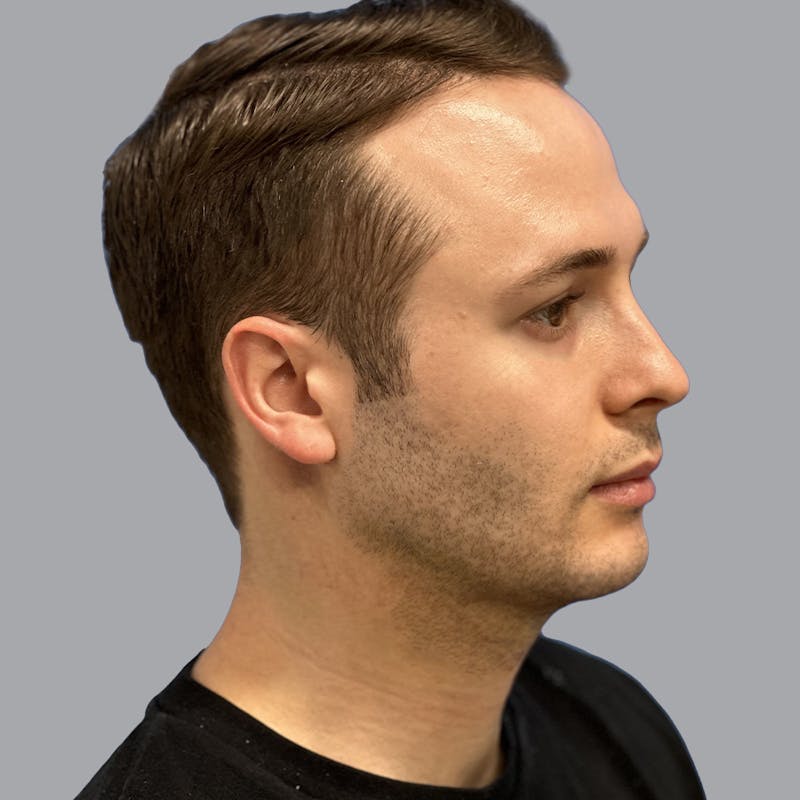 Chin Lipo Before & After Gallery - Patient 233029 - Image 2