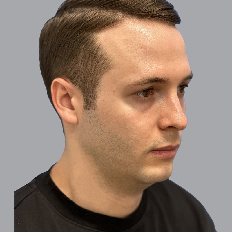 Chin Lipo Before & After Gallery - Patient 233029 - Image 1