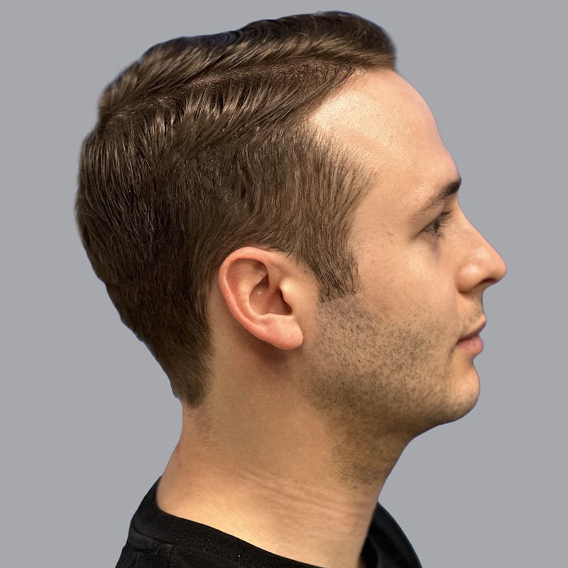 Chin Lipo Before & After Gallery - Patient 233029 - Image 4