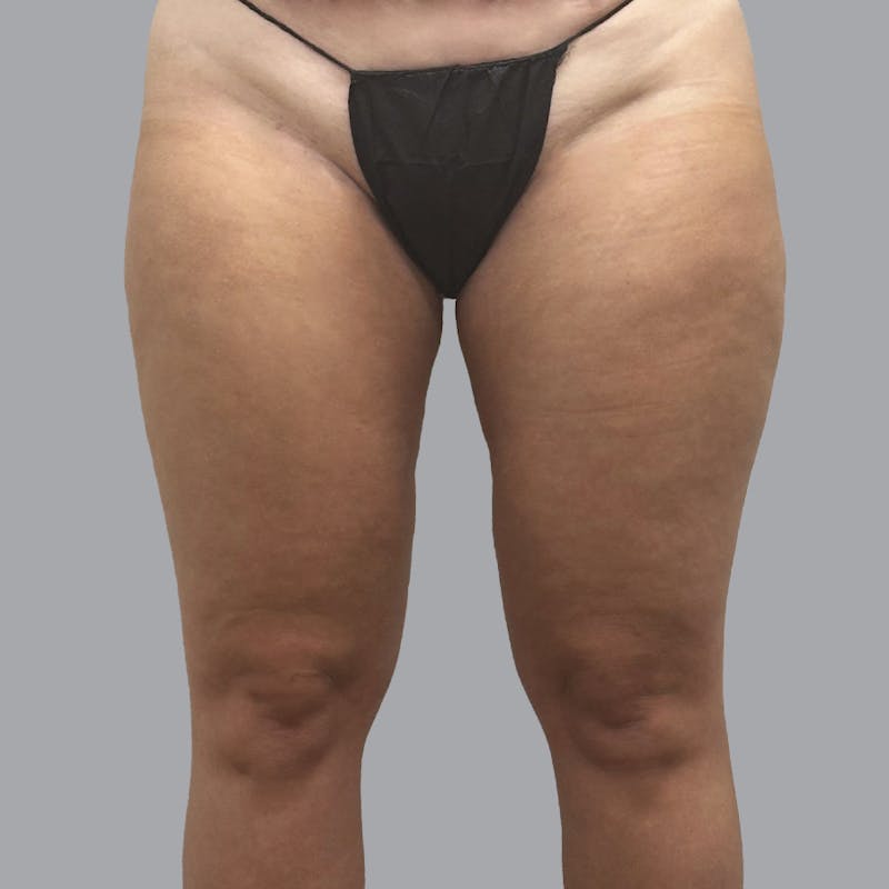Leg Liposuction Before & After Gallery - Patient 337220 - Image 2