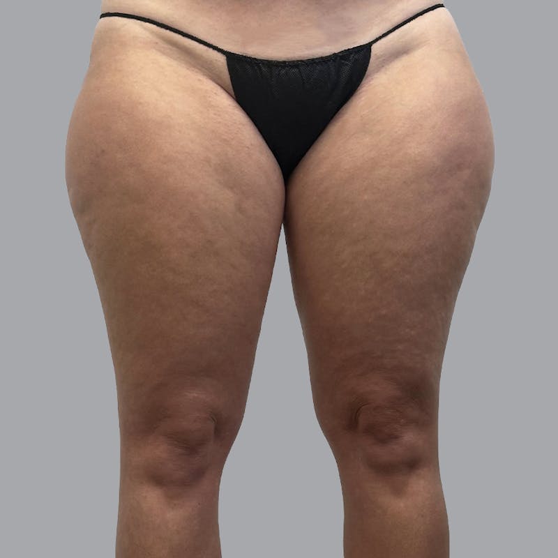 Leg Liposuction Before & After Gallery - Patient 337220 - Image 1