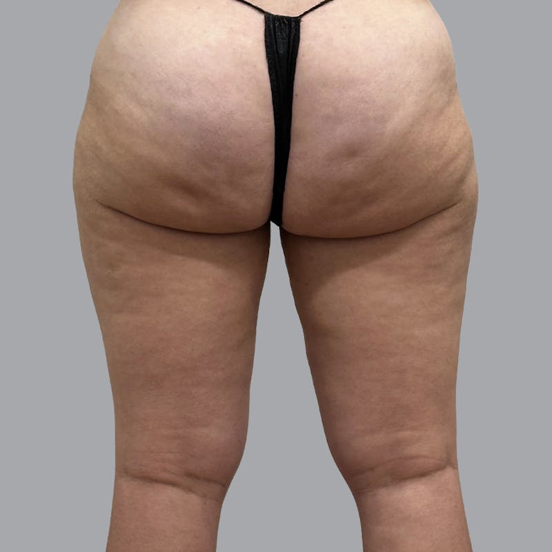 Leg Liposuction Before & After Gallery - Patient 334021 - Image 2