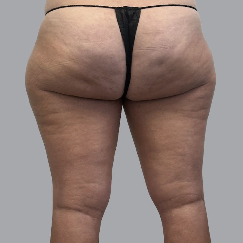 Leg Liposuction Before & After Gallery - Patient 334021 - Image 1