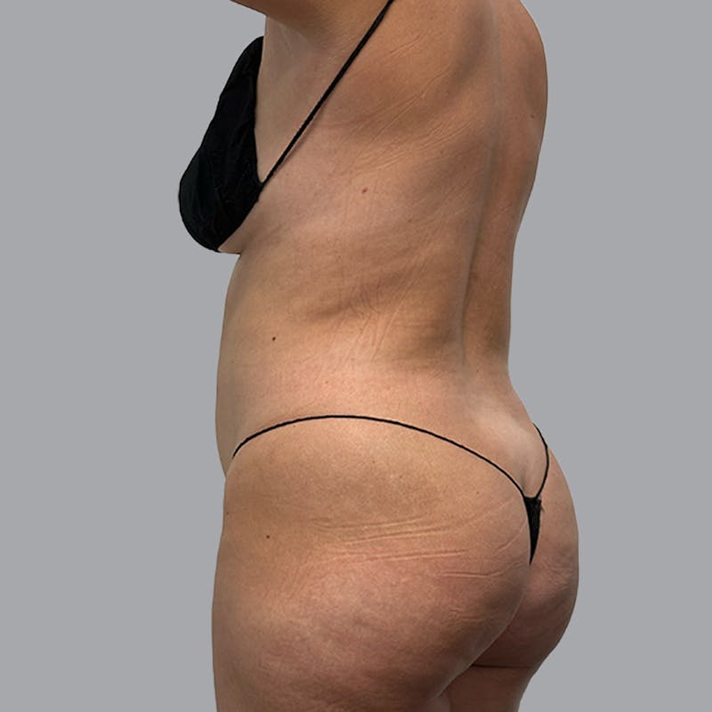 Brazilian Butt Lift and Hip Dip Before & After Gallery - Patient 299489 - Image 3