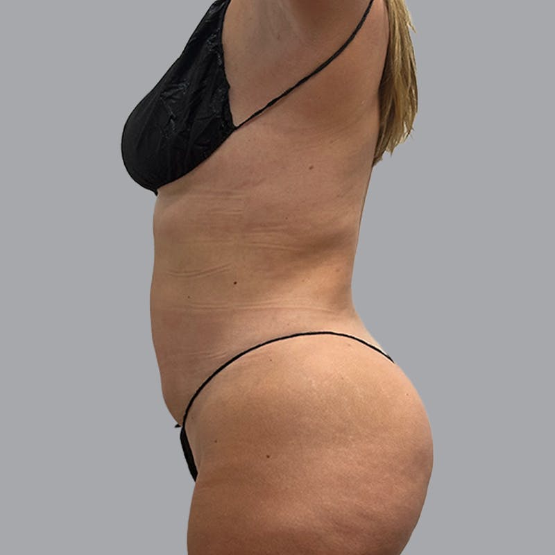 Body Liposuction Before & After Gallery - Patient 221103 - Image 6