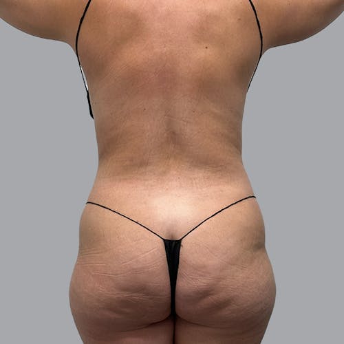 BBL Tampa  Brazilian Butt Lift by Dr. Markelov