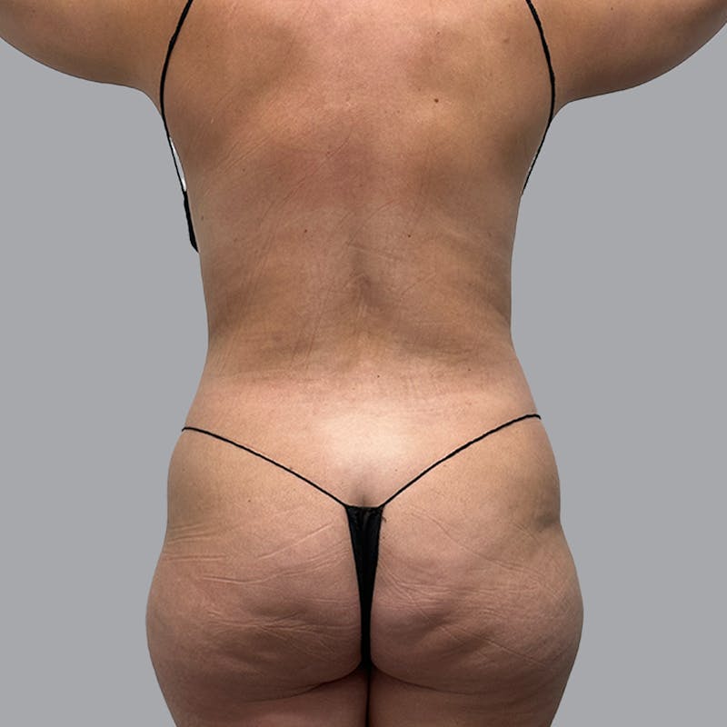 Body Liposuction Before & After Gallery - Patient 221103 - Image 1