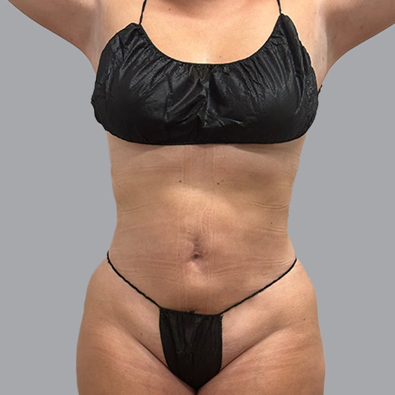 Body Liposuction Before & After Gallery - Patient 221103 - Image 8
