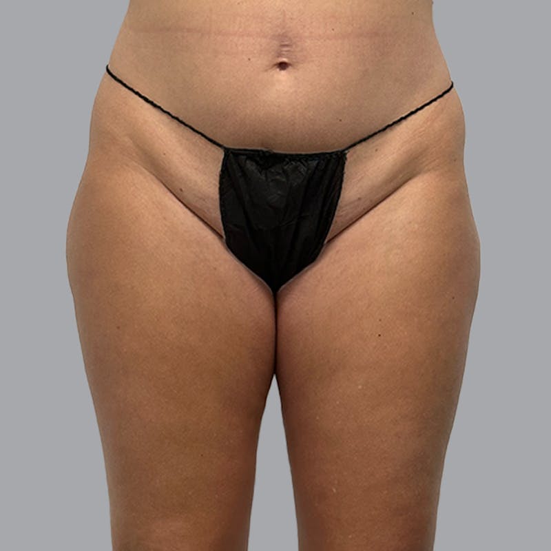 Brazilian Butt Lift and Hip Dip Before & After Gallery - Patient 260226 - Image 7