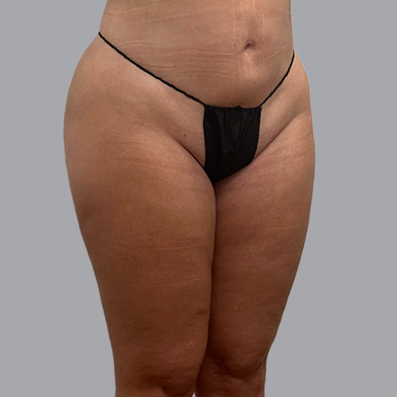 Brazilian Butt Lift and Hip Dip Before & After Gallery - Patient 260226 - Image 6
