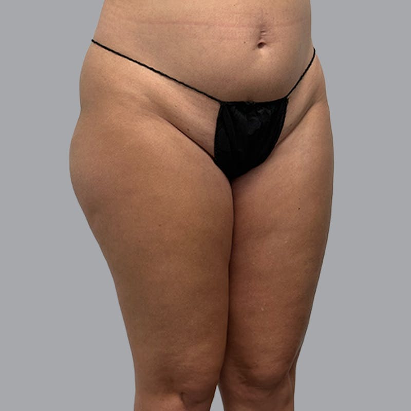 Brazilian Butt Lift and Hip Dip Before & After Gallery - Patient 260226 - Image 5