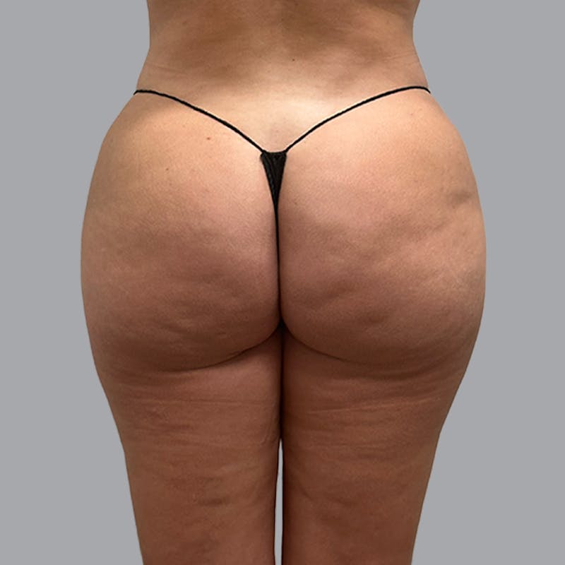 Brazilian Butt Lift and Hip Dip Before & After Gallery - Patient 260226 - Image 2