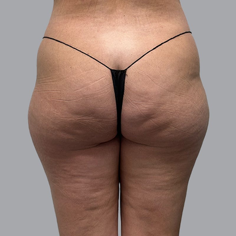 Brazilian Butt Lift and Hip Dip Before & After Gallery - Patient 260226 - Image 1