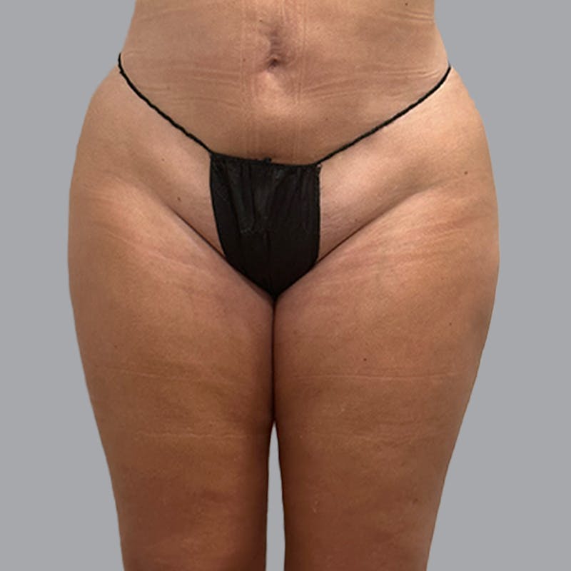 Brazilian Butt Lift and Hip Dip Before & After Gallery - Patient 260226 - Image 8