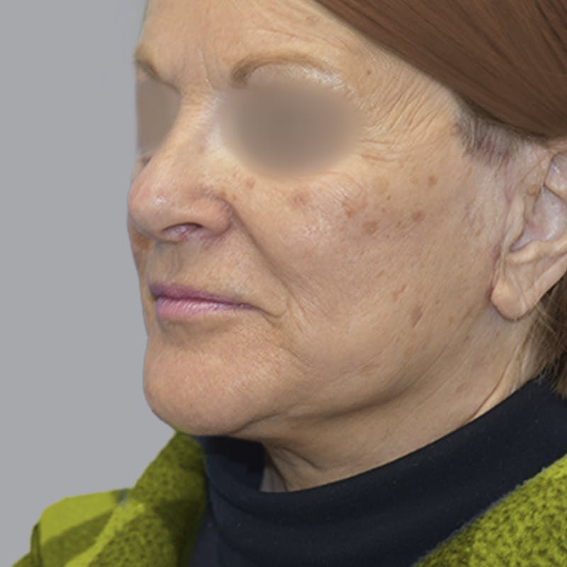 Facelift and Neck Lift Before & After Gallery - Patient 413920 - Image 4