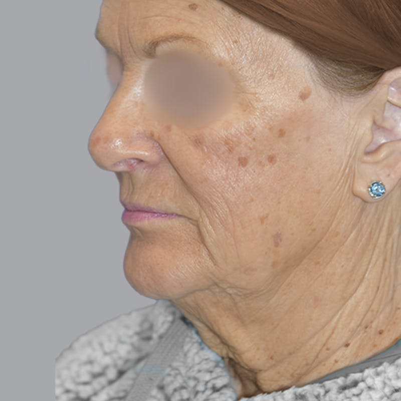 Facelift and Neck Lift Before & After Gallery - Patient 413920 - Image 3